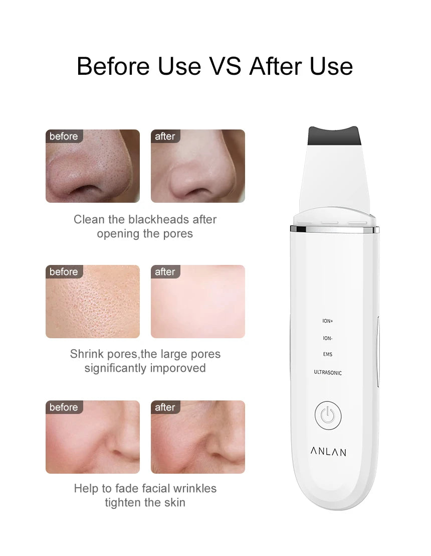 ANLAN Ultrasonic Skin Scrubber Deep Cleaning Limpieza Facial Pore Spatula EMS Facial Lifting Ultrasonic Peeling Skin Care Tool